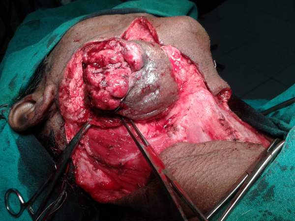 Cancer Operation in Bilaspur