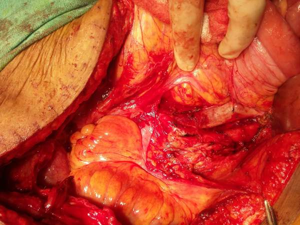 Best Cancer Doctor in Bilaspur